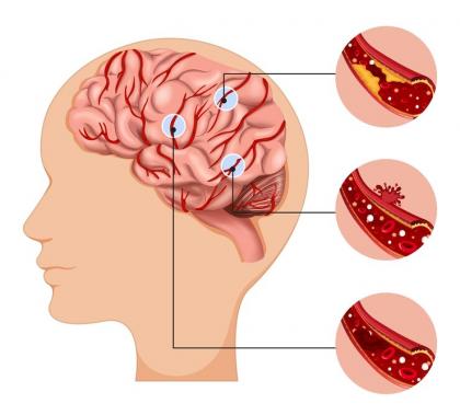 Расстройство кровоснабжения головного мозга: причины, симптомы, лечение